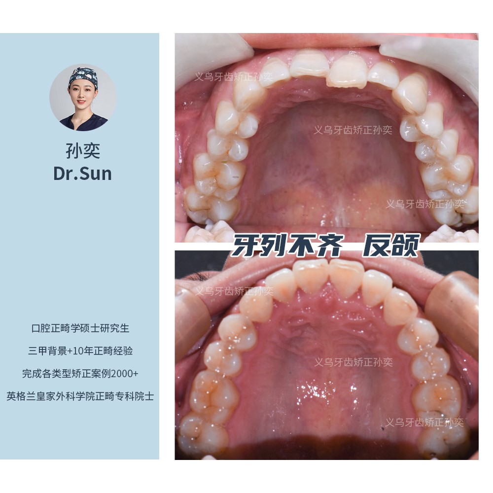 义乌傅氏口腔牙列不齐，反颌矫正案例分享！