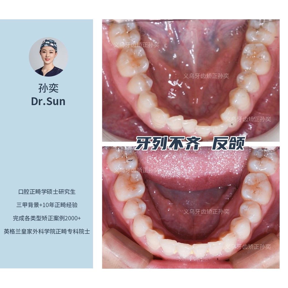 义乌傅氏口腔牙列不齐，反颌矫正案例分享！