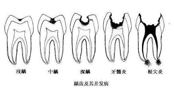 蛀牙不痛更得补！
