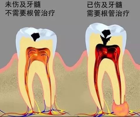 蛀牙不痛更得补！