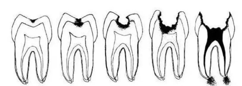 等有一天去补牙，这些情况你要知道！—义乌傅氏口腔