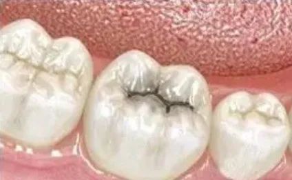 等有一天去补牙，这些情况你要知道！—义乌傅氏口腔