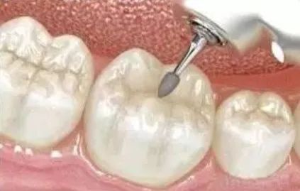 等有一天去补牙，这些情况你要知道！—义乌傅氏口腔