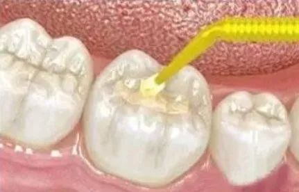 等有一天去补牙，这些情况你要知道！—义乌傅氏口腔