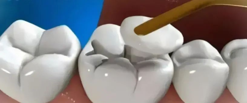 等有一天去补牙，这些情况你要知道！—义乌傅氏口腔