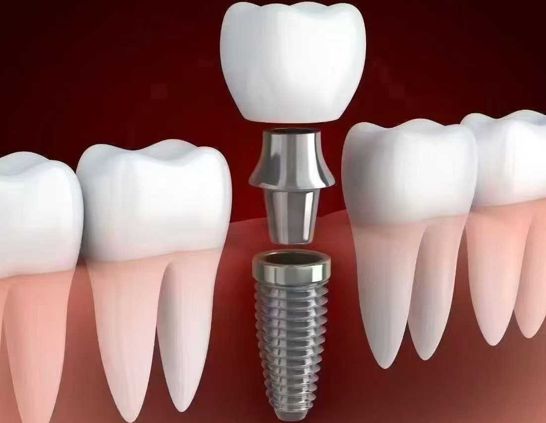 种植牙可以即拔即种吗?—义乌口腔修复 种植牙可以即拔即种吗?—义乌口腔修复