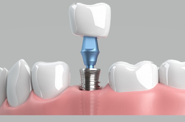 种植牙可以即拔即种吗?—义乌口腔修复 种植牙可以即拔即种吗?—义乌口腔修复