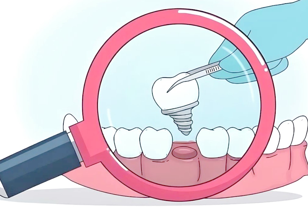 种植牙可以即拔即种吗?—义乌口腔修复 种植牙可以即拔即种吗?—义乌口腔修复