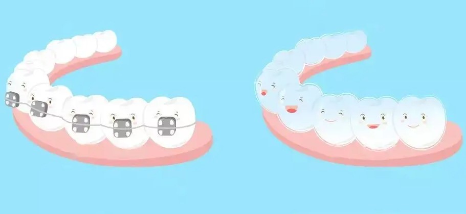 牙齿矫正是不是超级疼? 牙齿矫正是不是超级疼?