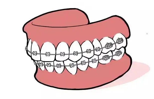 牙齿矫正是不是超级疼? 牙齿矫正是不是超级疼?