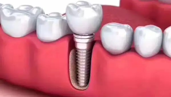 口腔修复中牙槽骨的处理! 口腔修复中牙槽骨的处理!