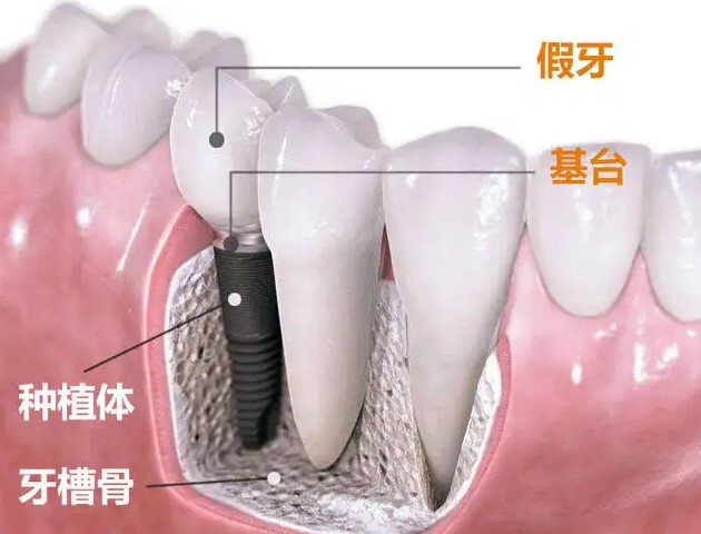 口腔修复中牙槽骨处理! 口腔修复中牙槽骨处理!
