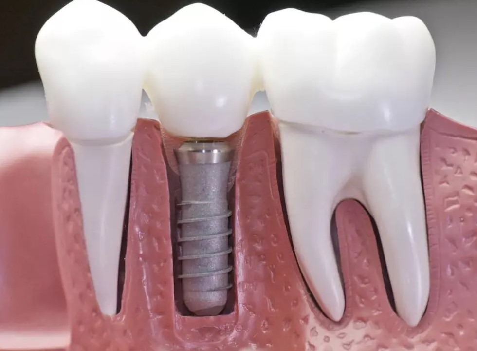 口腔修复中牙槽骨处理! 口腔修复中牙槽骨处理!