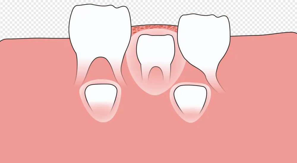 口腔修复中牙槽骨处理! 口腔修复中牙槽骨处理!