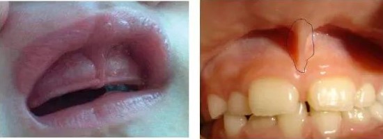 不一定知晓的唇系带! 不一定知晓的唇系带!