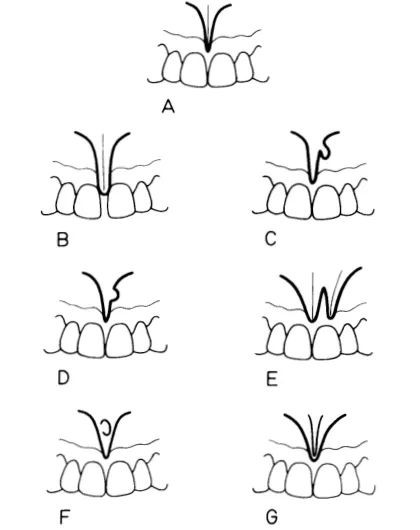 不一定知晓的唇系带! 不一定知晓的唇系带!