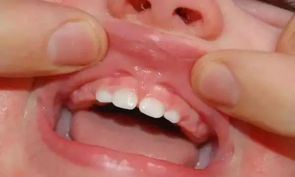 不一定知晓的唇系带! 不一定知晓的唇系带!