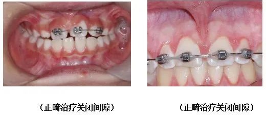 不一定知晓的唇系带! 不一定知晓的唇系带!