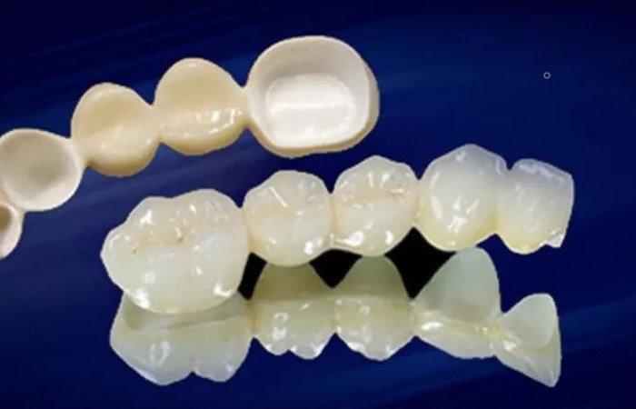 全瓷牙，从此让你摆脱牙龈黑线！—义乌傅氏口腔