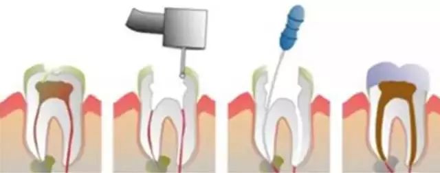 蛀牙补牙要趁早,不然你的钱包受不了!—义乌傅氏口腔 蛀牙补牙要趁早,不然你的钱包受不了!—义乌傅氏口腔