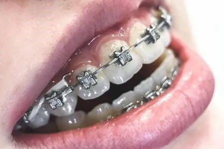 戴个牙套凭什么烧几个月工资?—义乌傅氏口腔 戴个牙套凭什么烧几个月工资?—义乌傅氏口腔