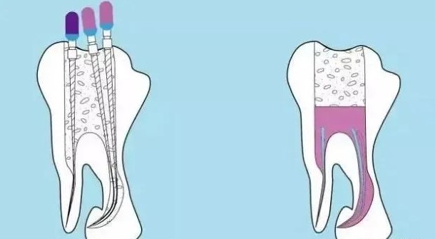 医生让戴牙冠，真的是为你的牙齿着想！—义乌口腔护理