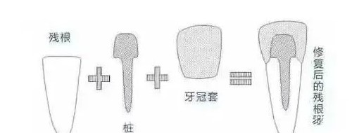 医生让戴牙冠，真的是为你的牙齿着想！—义乌口腔护理