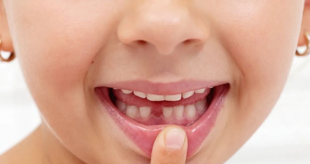 地包天有何危害,何时治疗比较好? 地包天有何危害,何时治疗比较好?