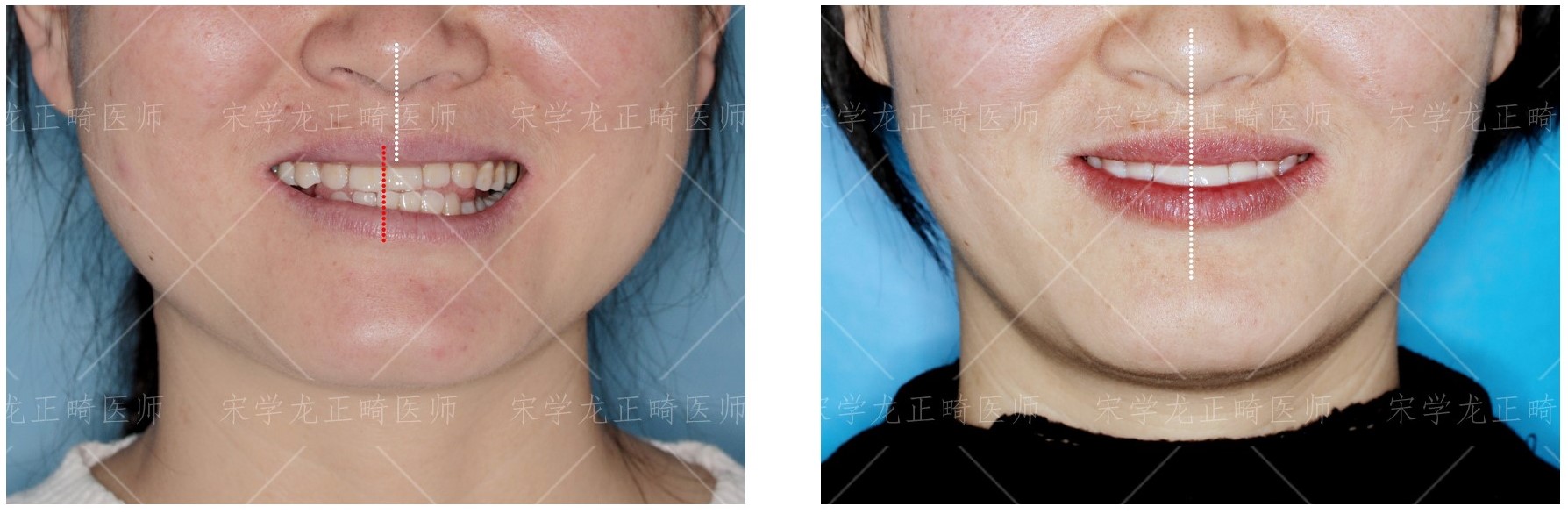 缩短复诊间隔就能加快矫牙速度？—义乌傅氏口腔