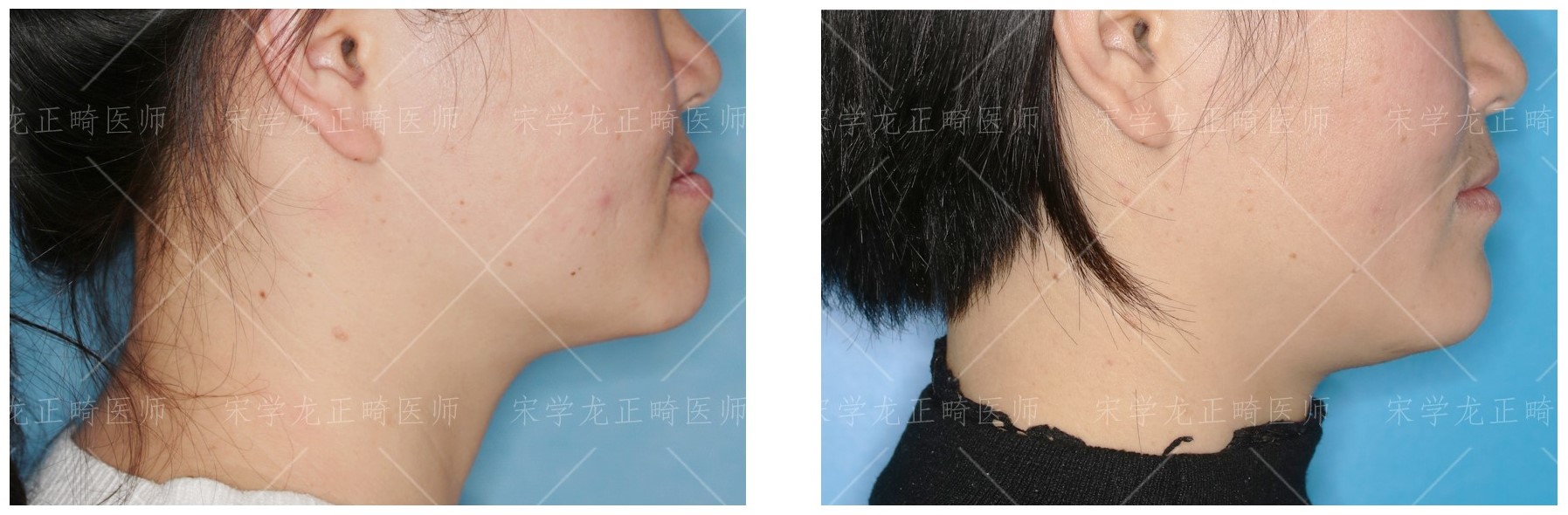 缩短复诊间隔就能加快矫牙速度？—义乌傅氏口腔