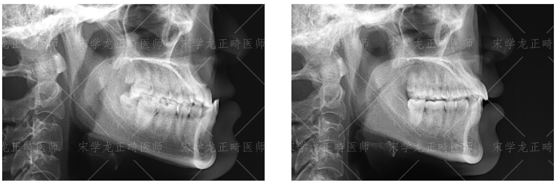 缩短复诊间隔就能加快矫牙速度？—义乌傅氏口腔