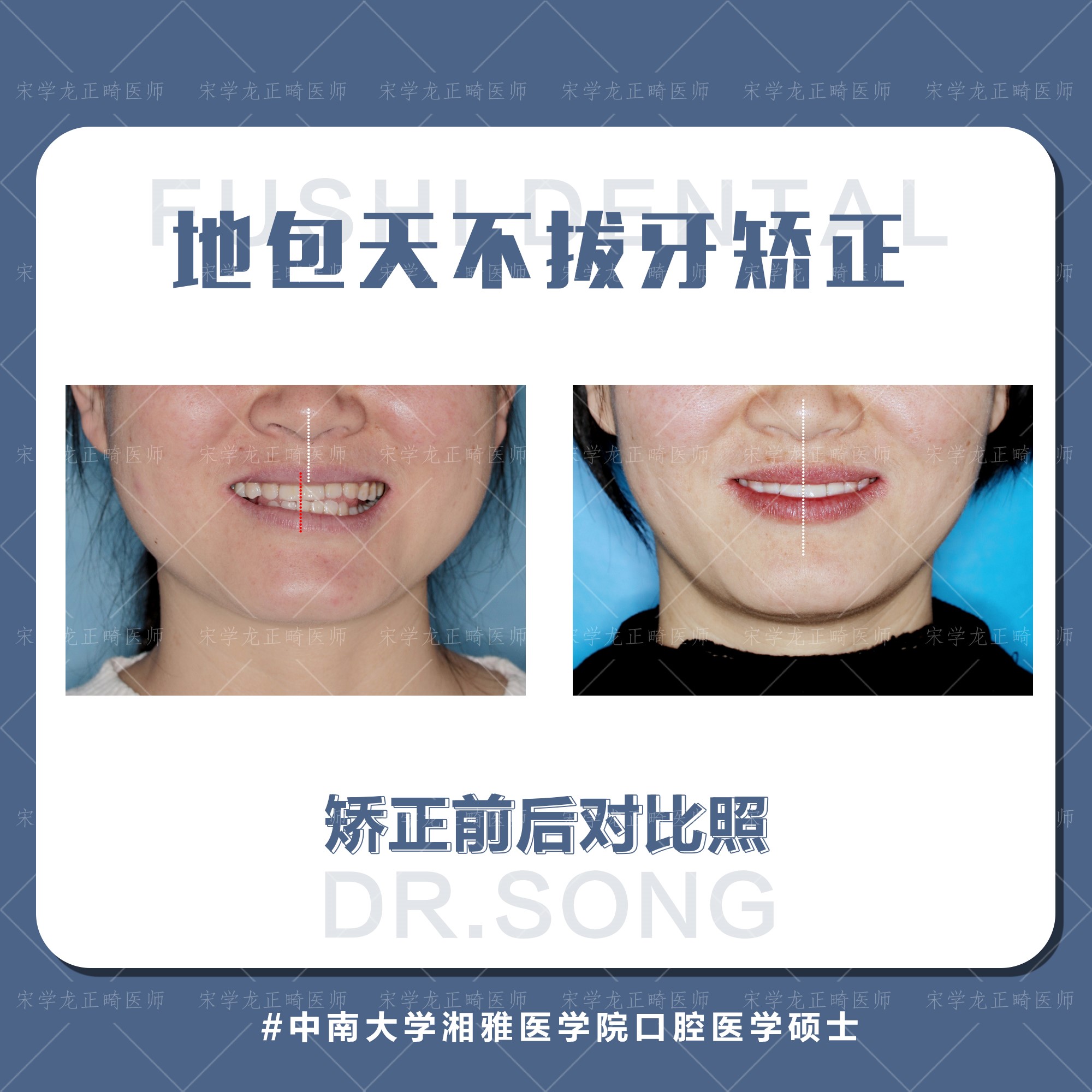 地包天女生不拔牙矫正-义乌傅氏口腔