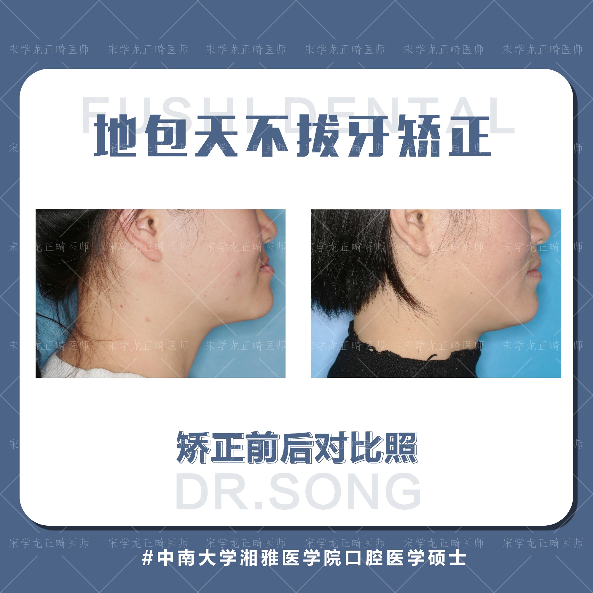 地包天女生不拔牙矫正-义乌傅氏口腔