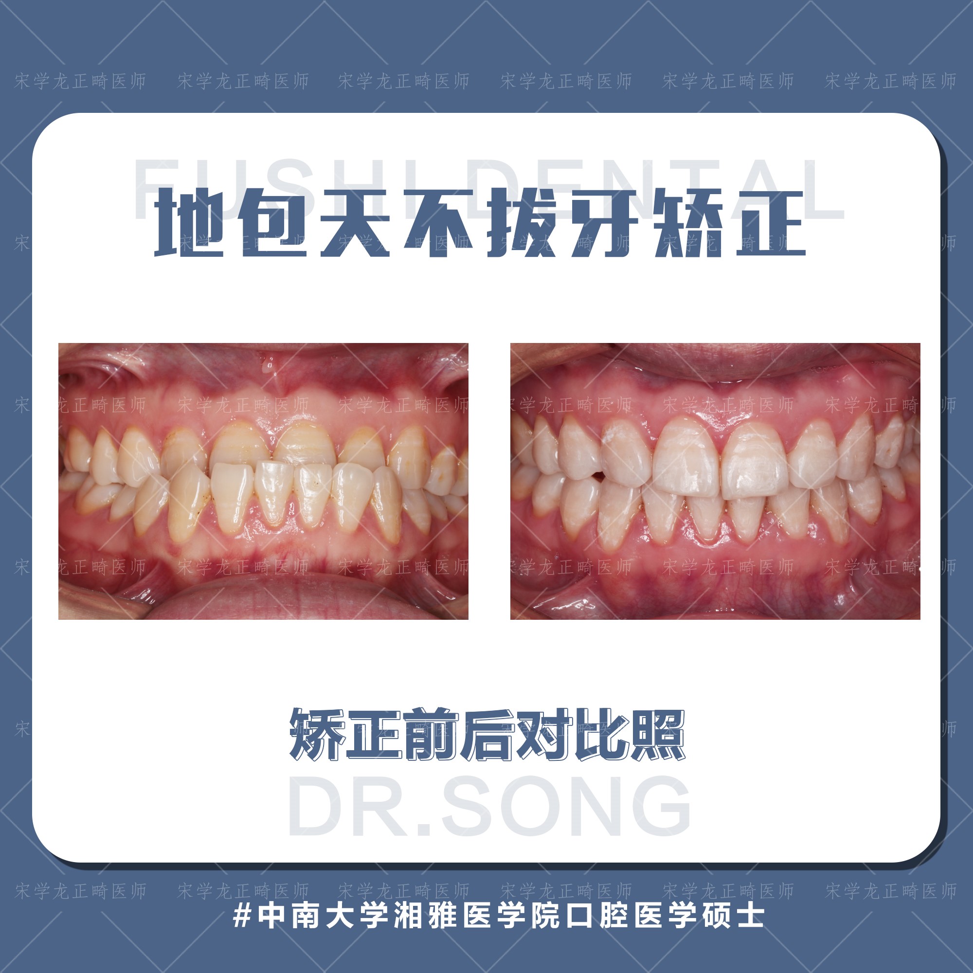 地包天女生不拔牙矫正-义乌傅氏口腔