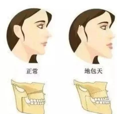 “地包天”有什么危害,什么年龄矫治好?—义乌傅氏口腔 “地包天”有什么危害,什么年龄矫治好?—义乌傅氏口腔