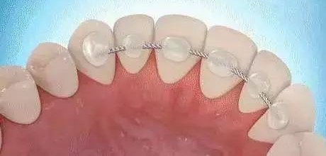 牙齿矫正完后，保持器要戴多久？