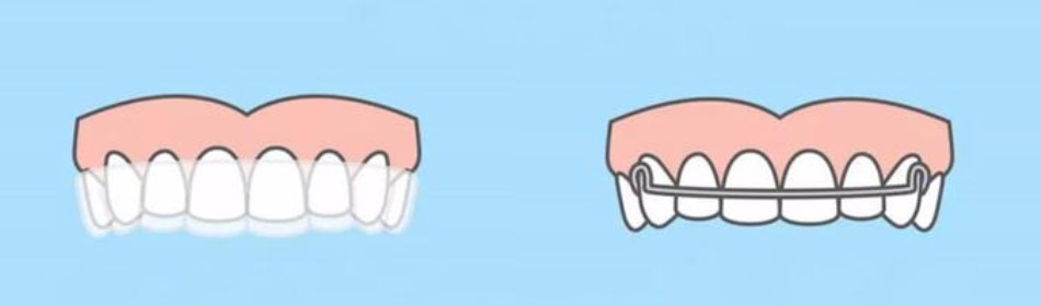 矫正小技巧，别问、问就是保持器一定要戴！