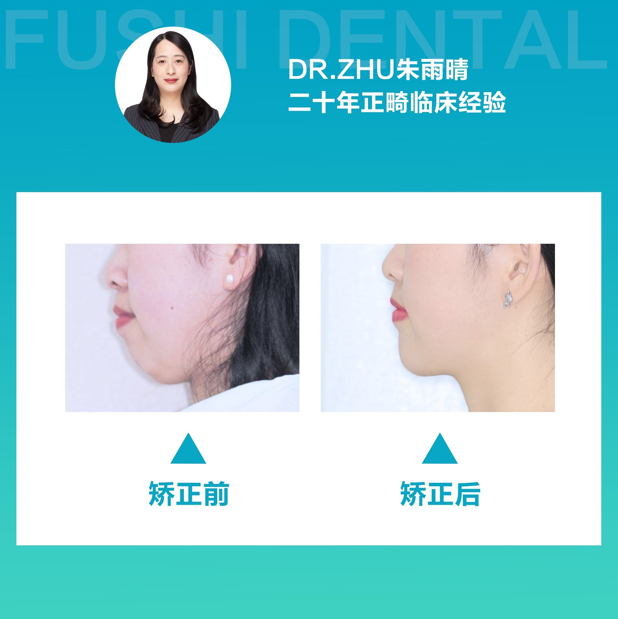 开颌女生牙齿矫正，颜值健康两不误！-义乌傅氏口腔