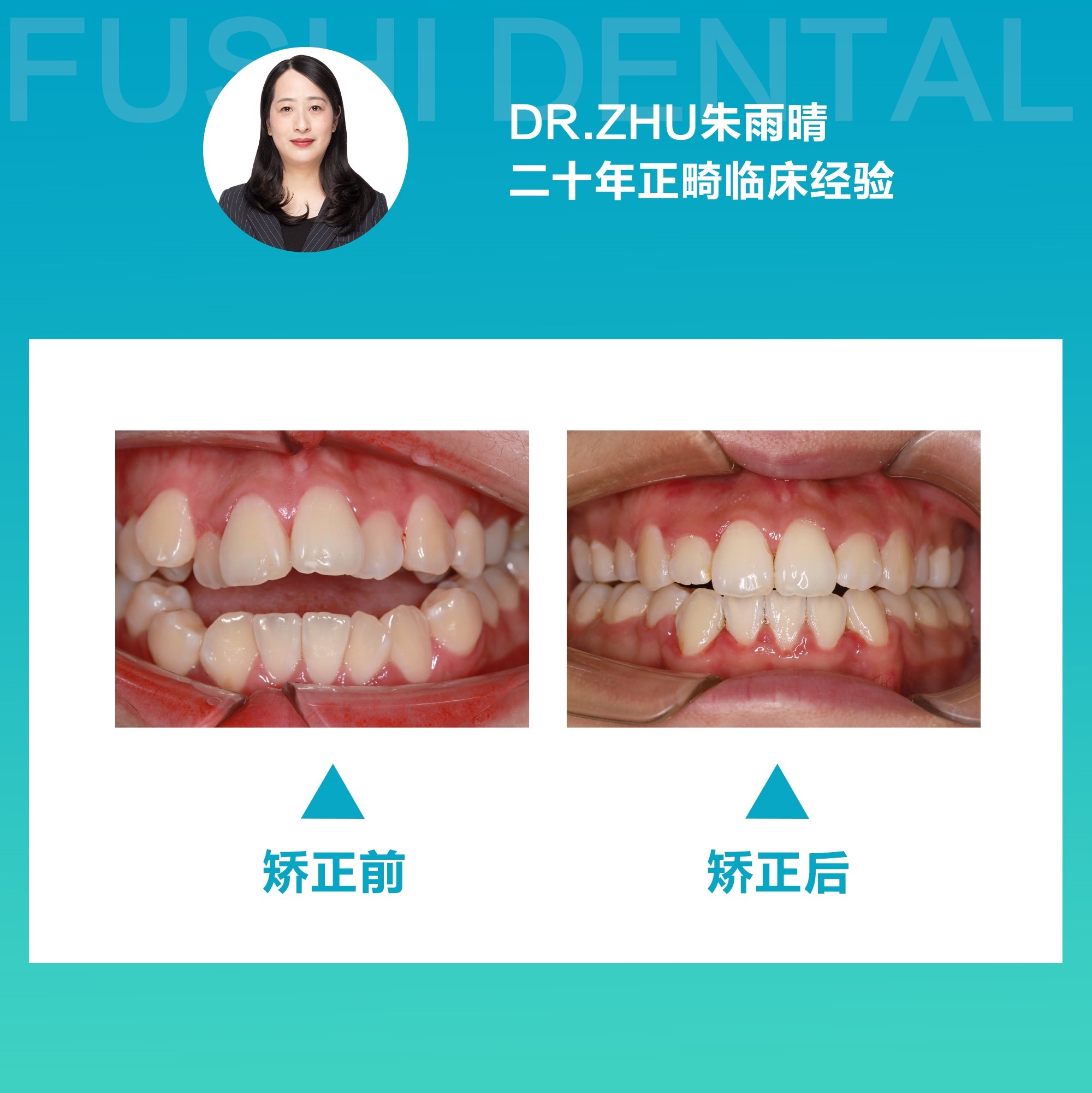 开颌女生牙齿矫正，颜值健康两不误！-义乌傅氏口腔