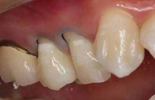 快停下！牙齿快被刷断了！—义乌傅氏口腔