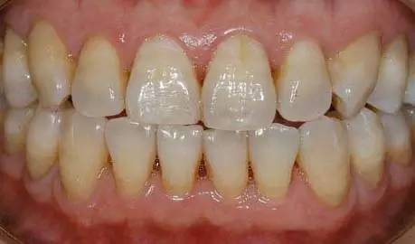 快停下！牙齿快被刷断了！—义乌傅氏口腔