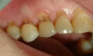 快停下！牙齿快被刷断了！—义乌傅氏口腔