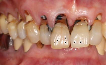 快停下！牙齿快被刷断了！—义乌傅氏口腔