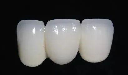 镶全瓷牙能用多久，有何优势？