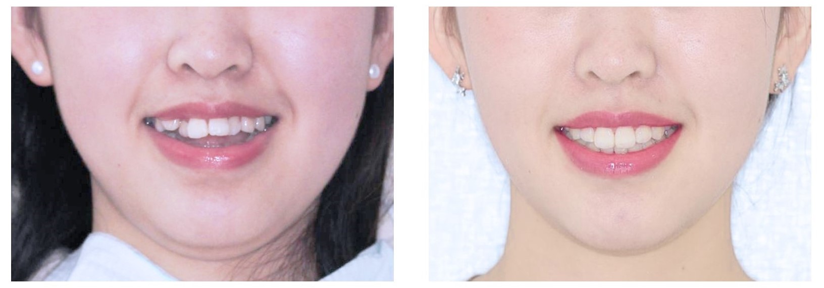 有人问牙齿矫正需要多久？—义乌傅氏口腔