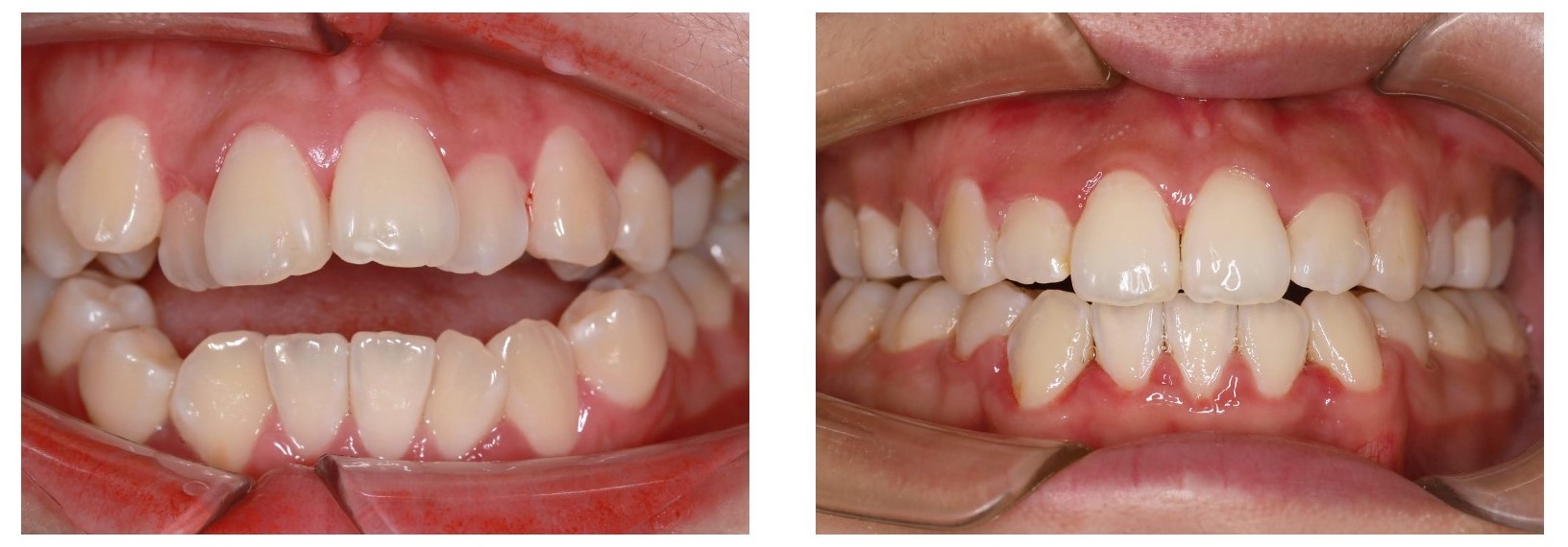 有人问牙齿矫正需要多久？—义乌傅氏口腔