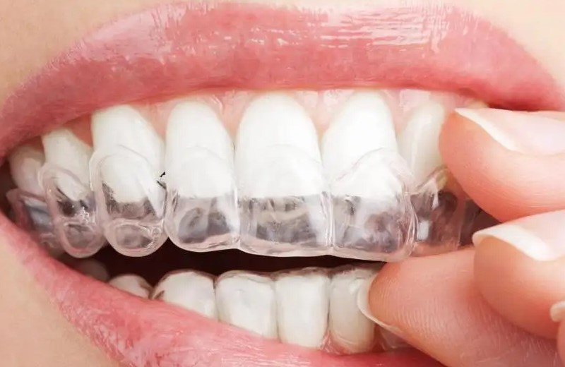 牙齿矫正需要多少钱？—义乌傅氏口腔