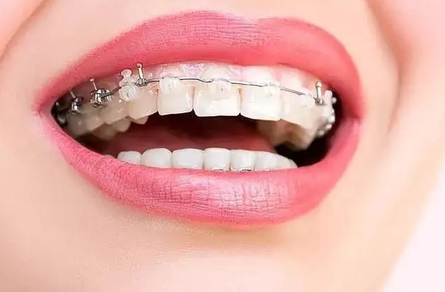 牙齿矫正需要多少钱？—义乌傅氏口腔