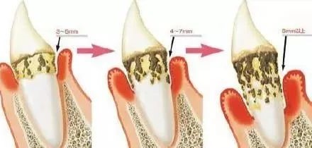得了牙周炎应该怎么办？