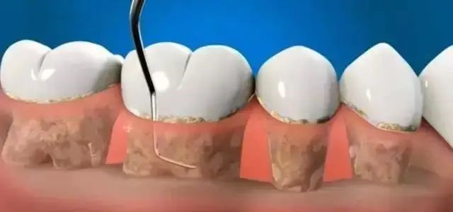 得了牙周炎应该怎么办？